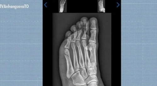 Candidato supera fratura no pé e passa em teste físico da PMTO